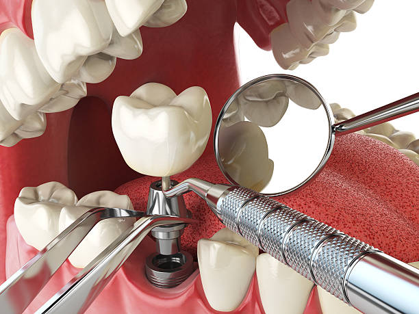 Best Broken or Cracked Tooth Emergency Dentist in Clover Creek, WA